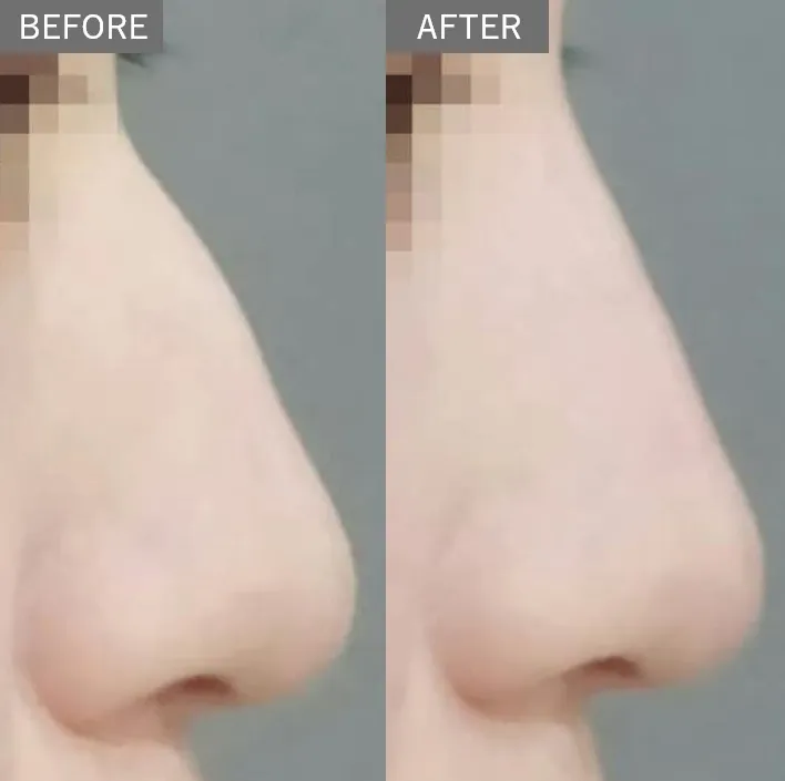 Nose Filler
