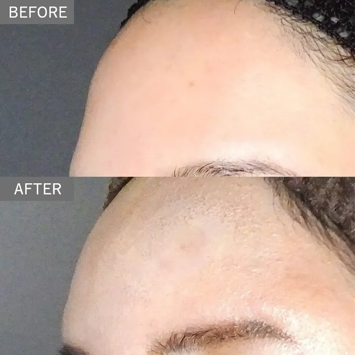 Forehead & Temple Contouring Injection