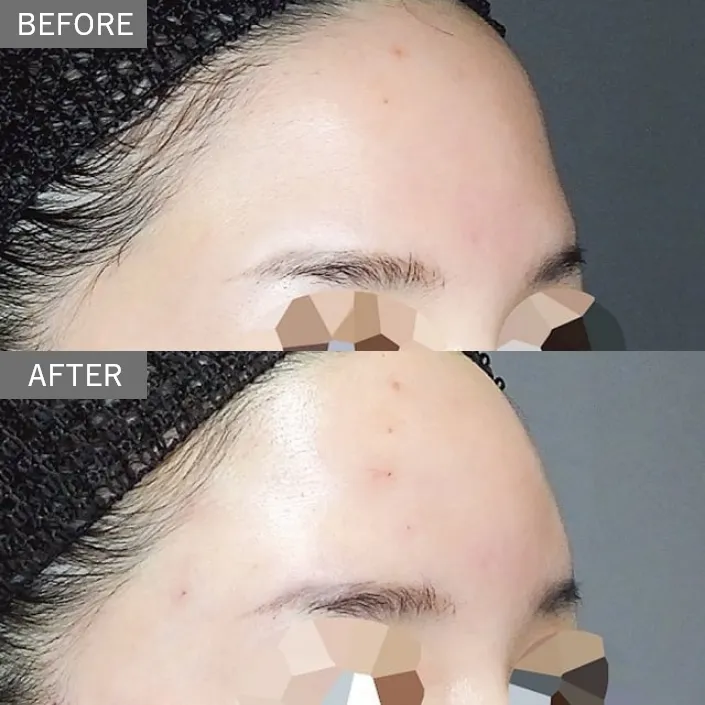 Forehead & Temple Contouring Injection
