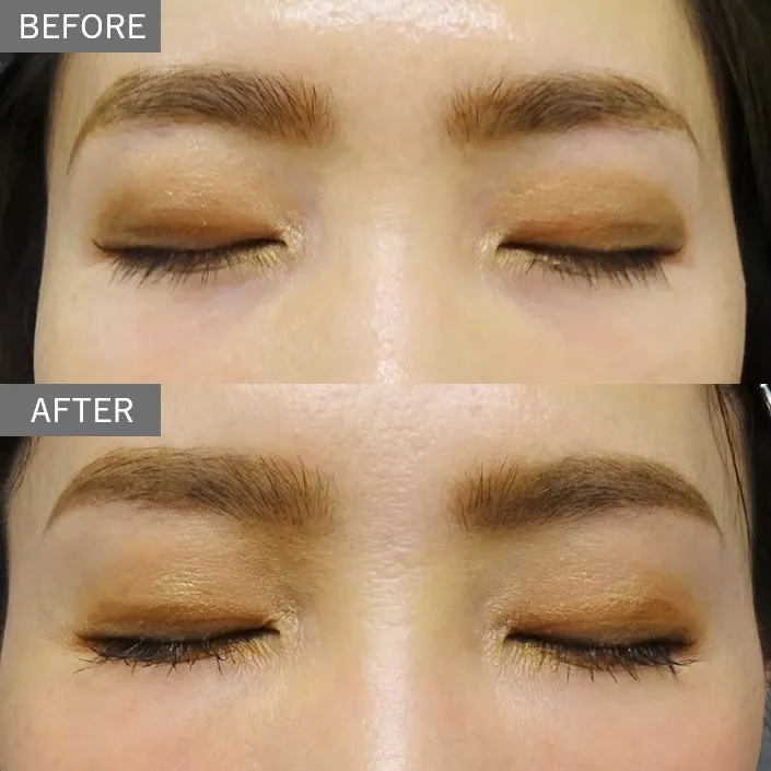 Under-Eye Filler
