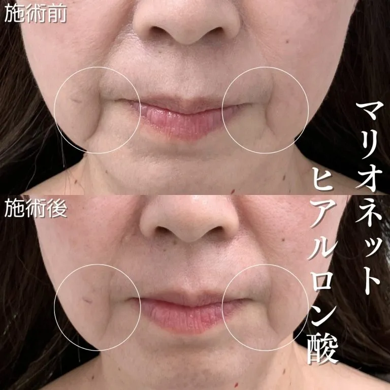Marionette Line Hyaluronic Acid Injection