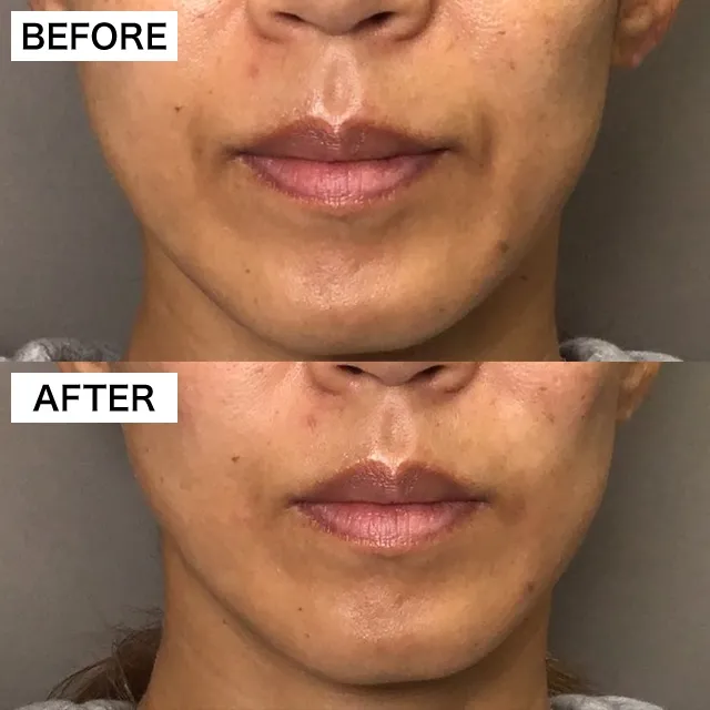Marionette Line Hyaluronic Acid Injection