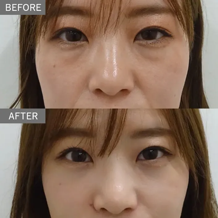 Nasojugal Fold (Golgo Line) Hyaluronic Acid Injection