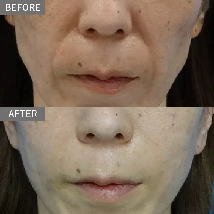 Nasojugal Fold (Golgo Line) Hyaluronic Acid Injection