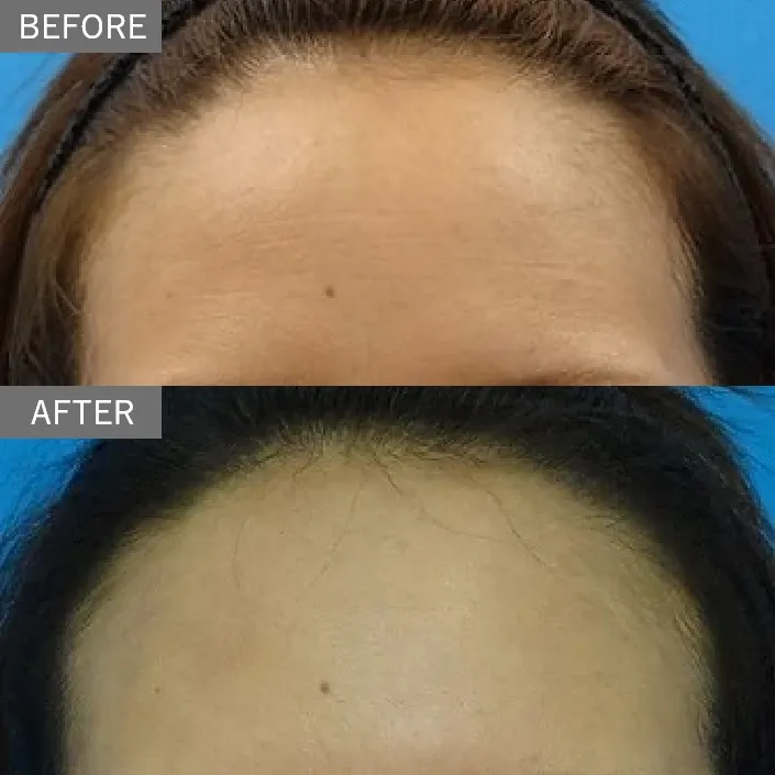 Forehead Wrinkle Treatment