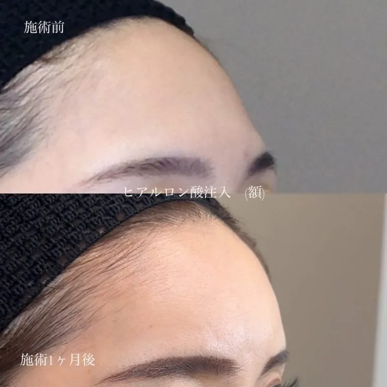 Forehead Wrinkle Treatment