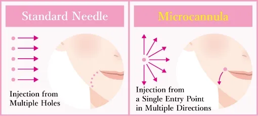 Hyaluronic acid injection effect