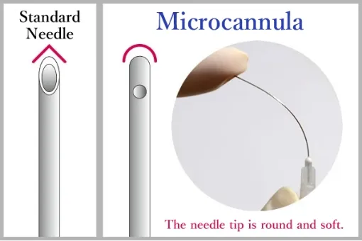 Hyaluronic acid injection effect