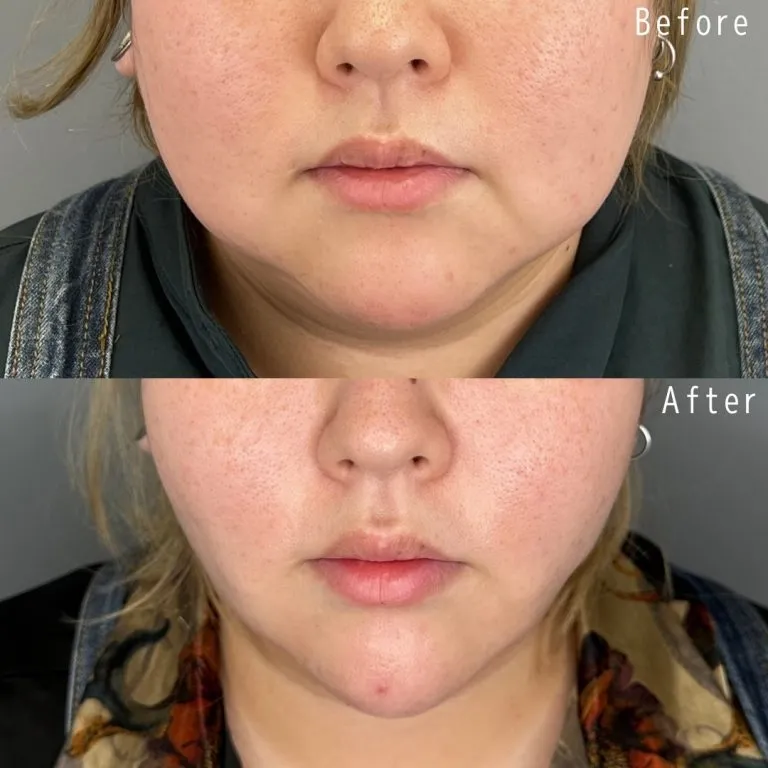 Facial Liposuction