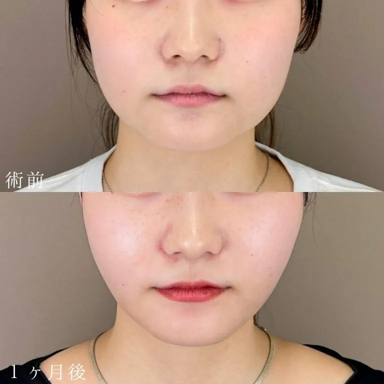 Facial Liposuction