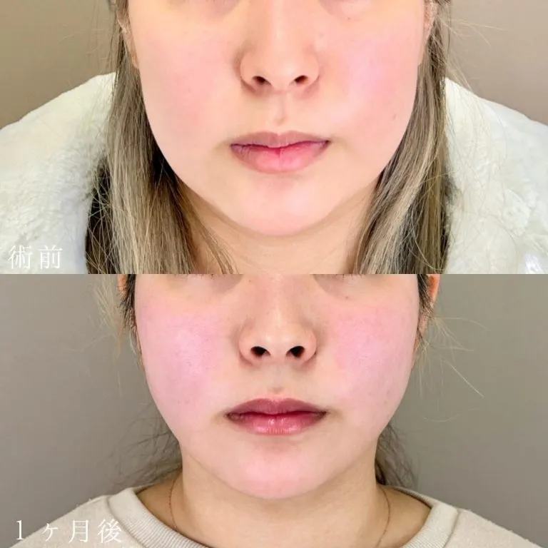 Facial Liposuction