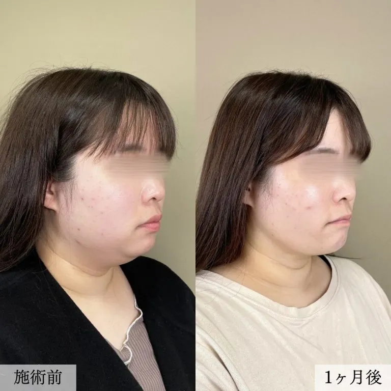 Facial Liposuction