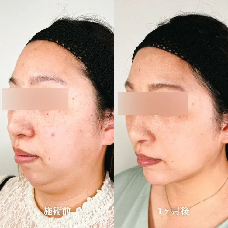 Facial Liposuction