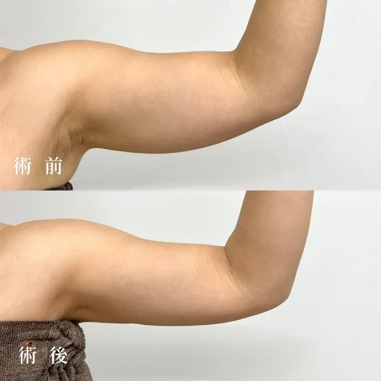 Upper Arm & Shoulder Liposuction
