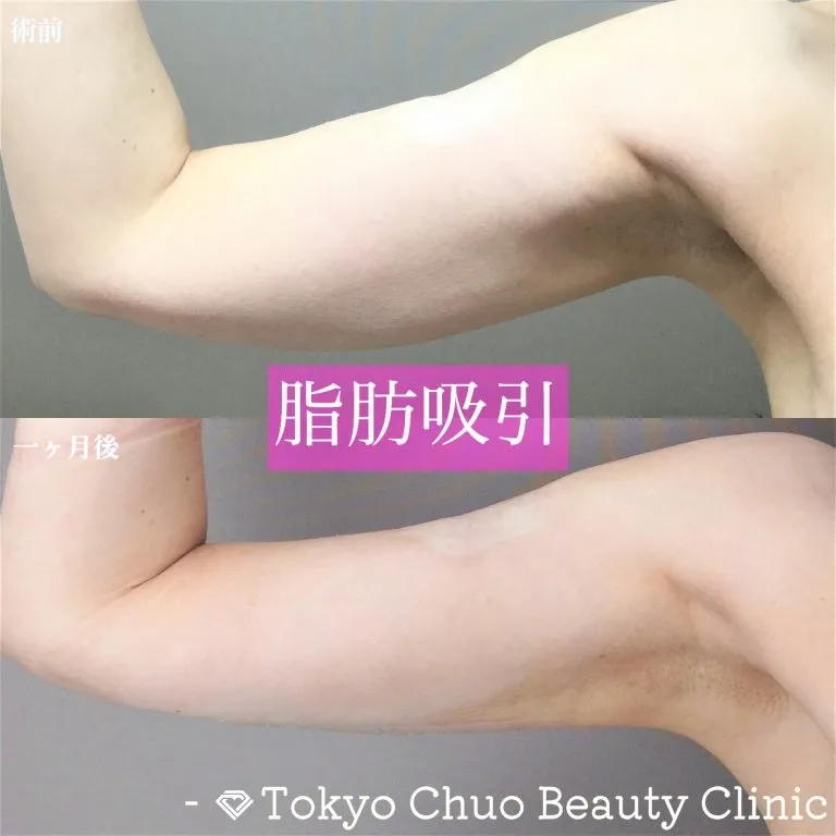 Upper Arm & Shoulder Liposuction