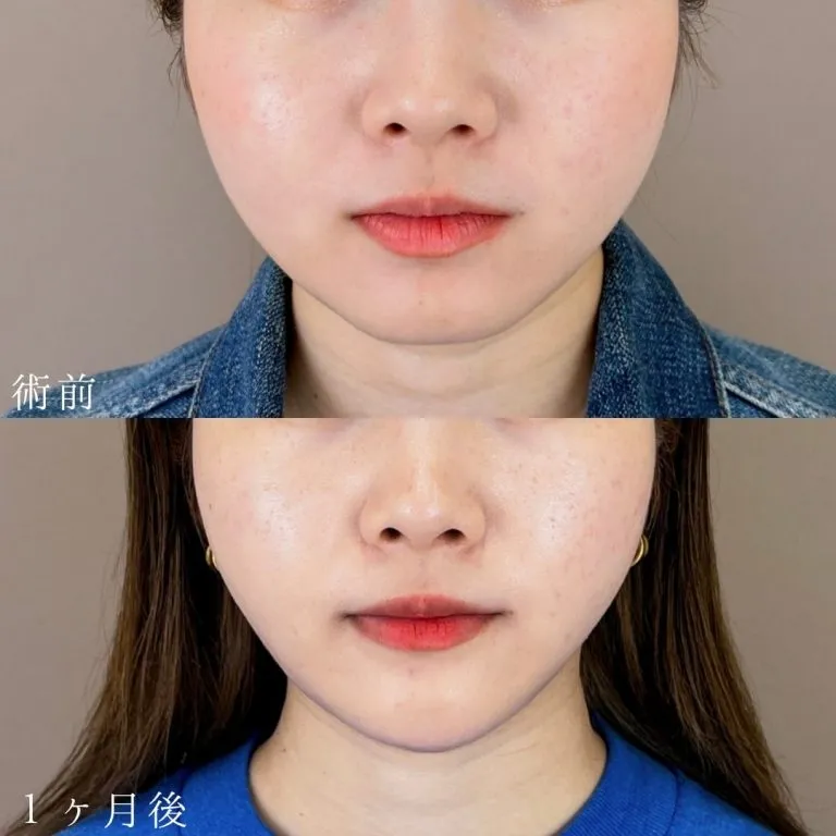 Before & After Photos of Facial Liposuction
