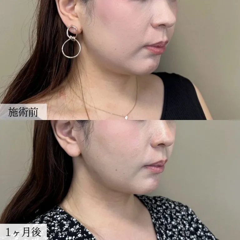 Before & After Photos of Facial Liposuction
