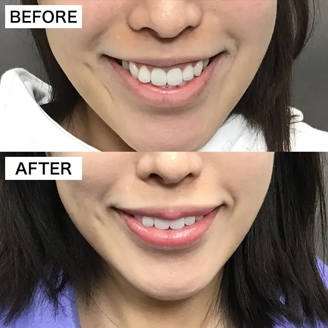  Gummy Smile Treatment