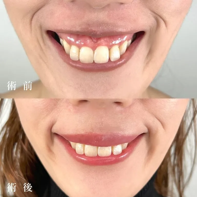  Gummy Smile Treatment