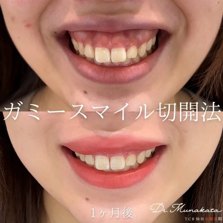  Gummy Smile Treatment