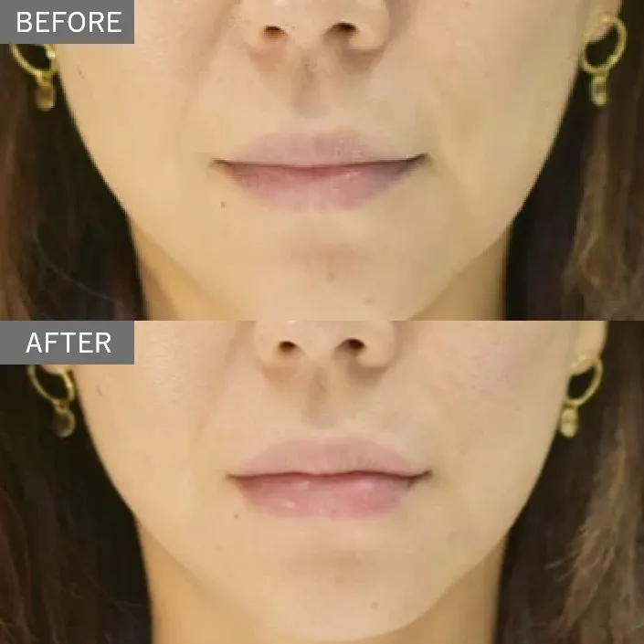 Mouth Corner Botox