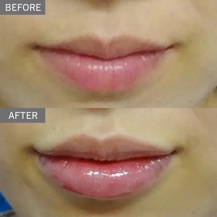 Lip filler (hyaluronic acid injection) 