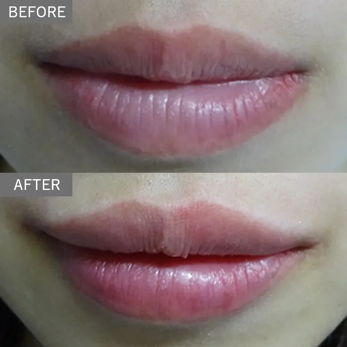Lip filler (hyaluronic acid injection) 