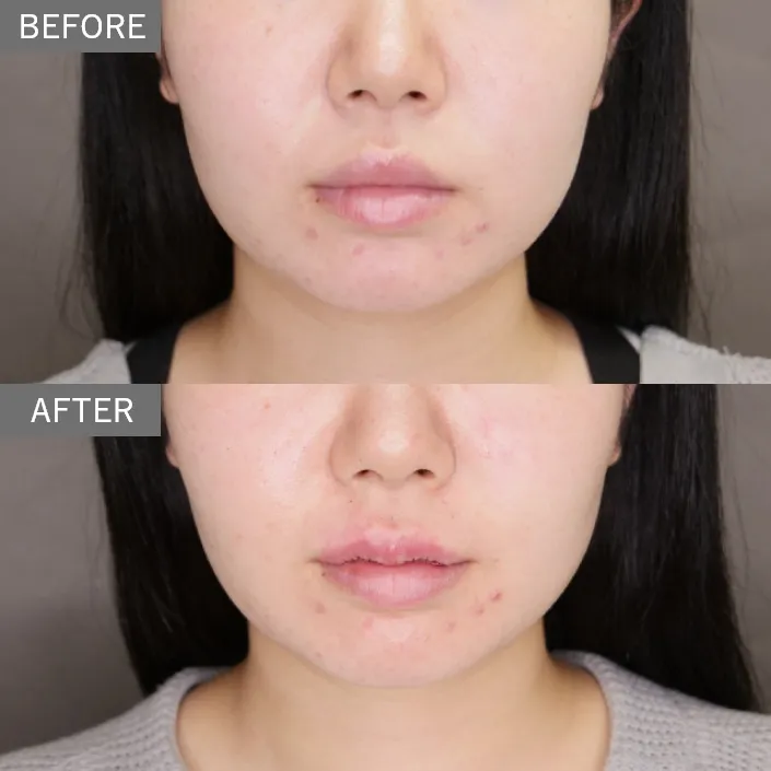 M-Shaped Lip surgery