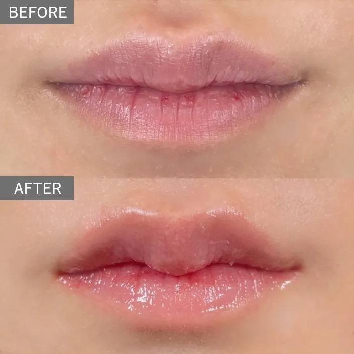 M-Shaped Lip surgery