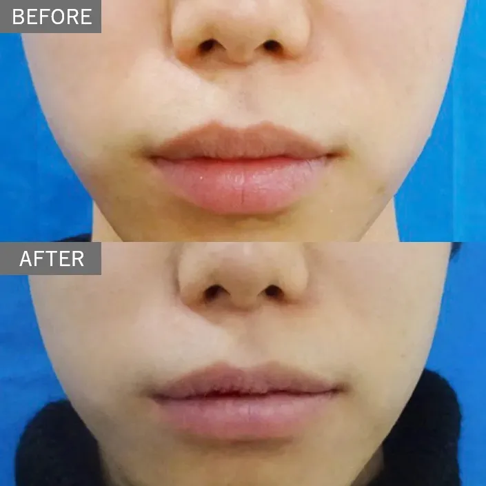 Smart Lip (thick lip reduction)