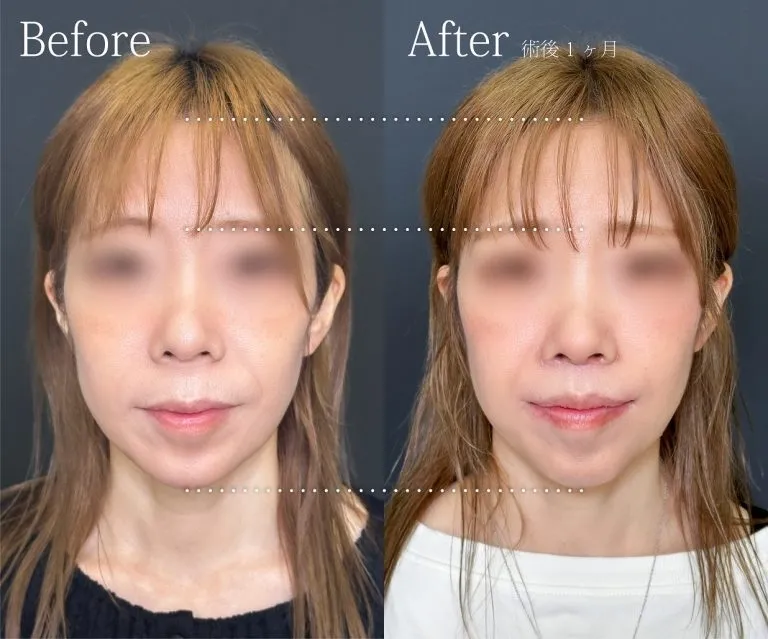 Mouth corner lift
