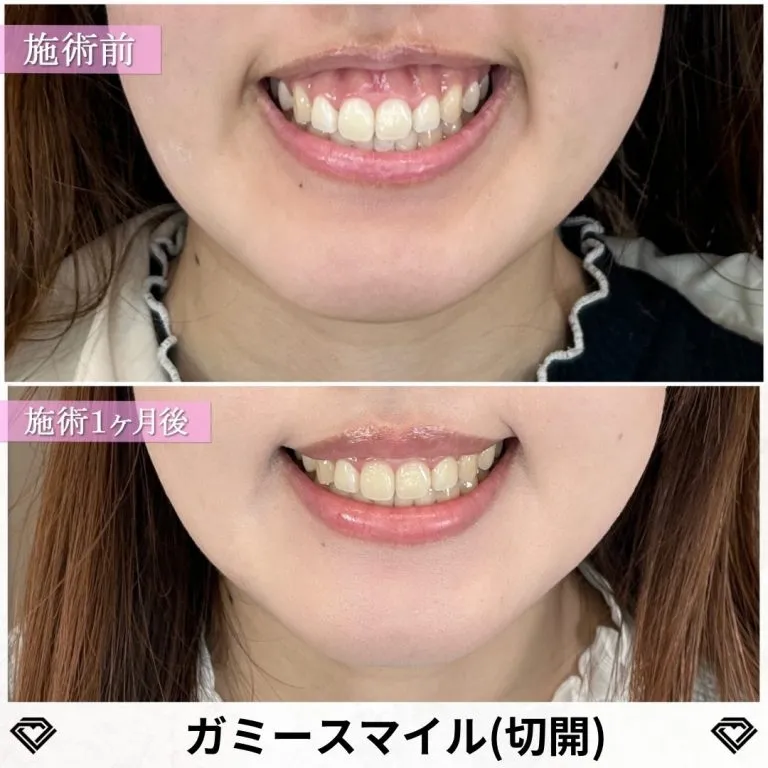 Gummy Smile treatment (surgical method)