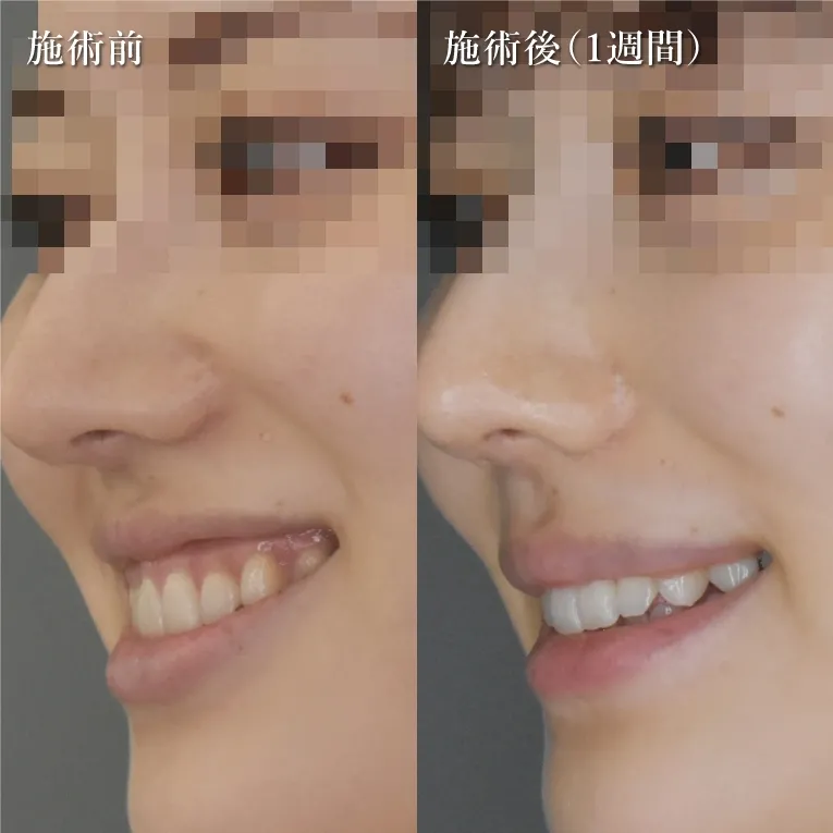 Gummy Smile treatment (surgical method)