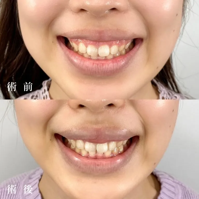 Gummy Smile treatment (surgical method)