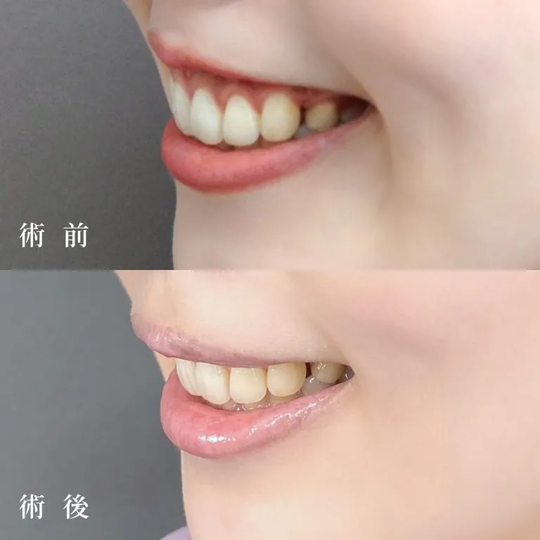 Gummy Smile treatment (surgical method)