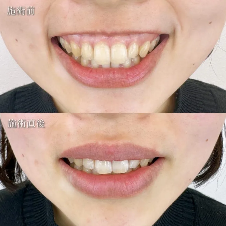 Gummy Smile treatment (surgical method)