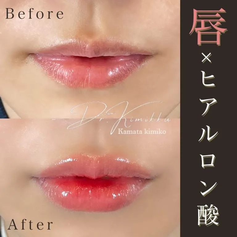 Lip filler (hyaluronic acid injection)