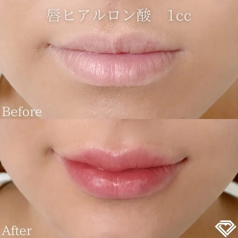 Lip filler (hyaluronic acid injection)
