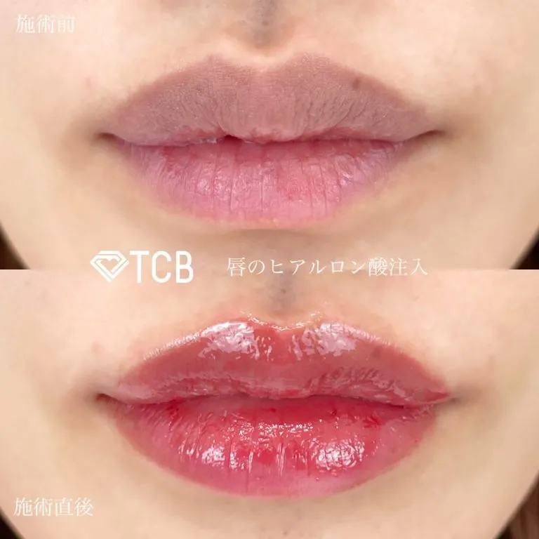 Lip filler (hyaluronic acid injection)