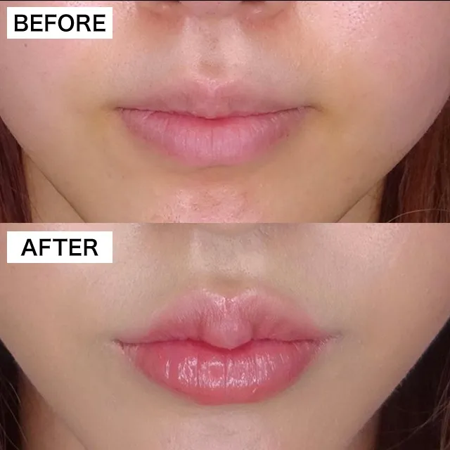 Lip filler (hyaluronic acid injection)