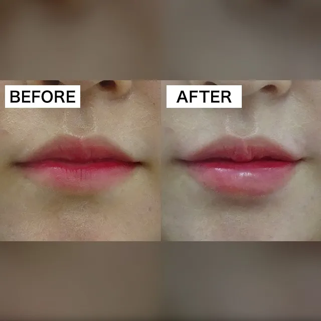 Lip filler (hyaluronic acid injection)