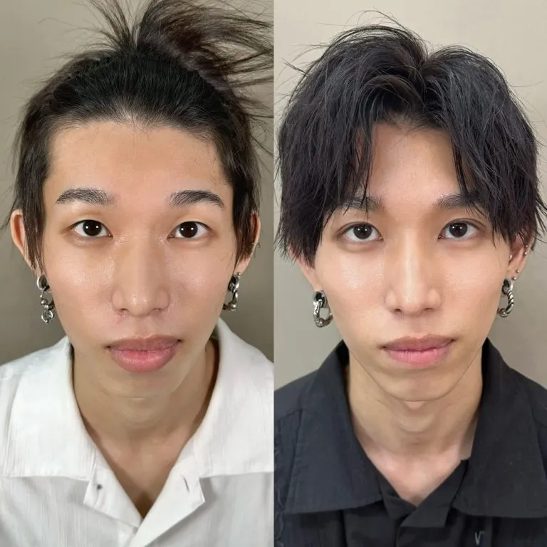 Smart Lip (thick lip reduction surgery)