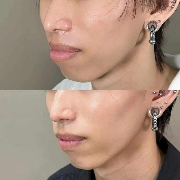 Smart Lip (thick lip reduction surgery)