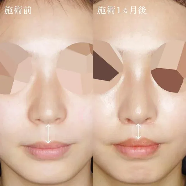 Philtrum Shortening (Lip Lift)_before