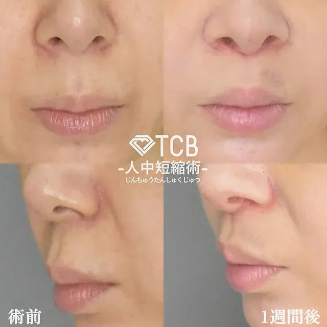 Philtrum Shortening (Lip Lift)_after