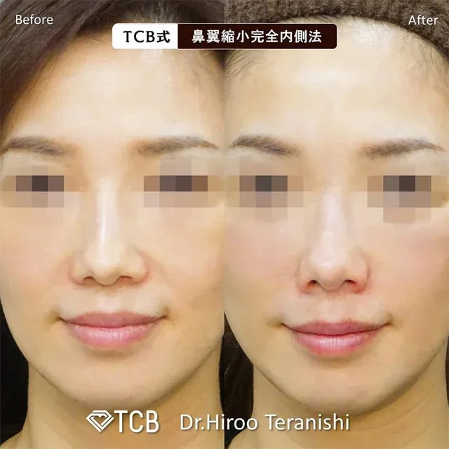 TCB Method Alar Reduction – Full Internal Approach_before