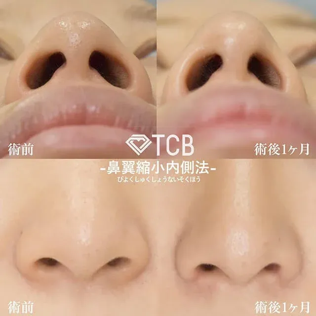 TCB Method Alar Reduction – Full Internal Approach_after