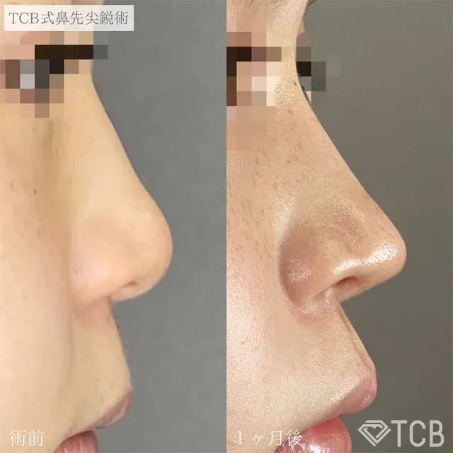 TCB Nose Tip Refinement (Bulbous Nose Correction)_before