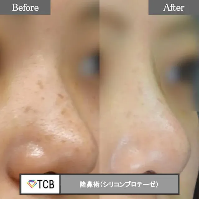 Augmentation Rhinoplasty (Silicone Implant)_after