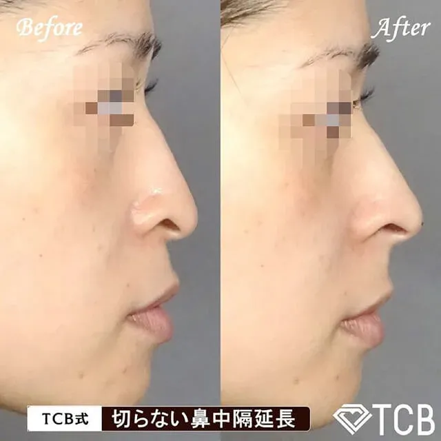 Non-Incisional Columella Lengthening_after